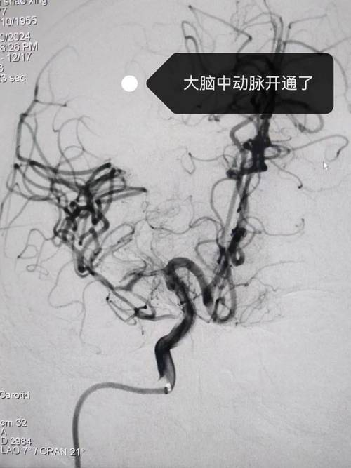 脑梗患者血管通路建立