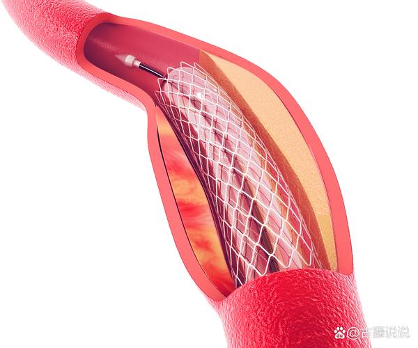 脑梗患者血管通路建立