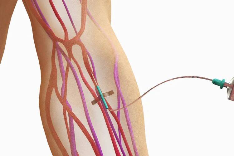 脑梗患者血管通路建立