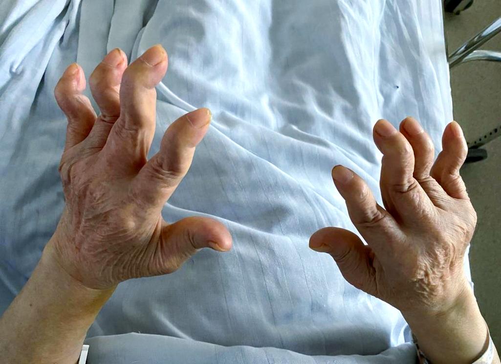 23岁得类风湿手指变形