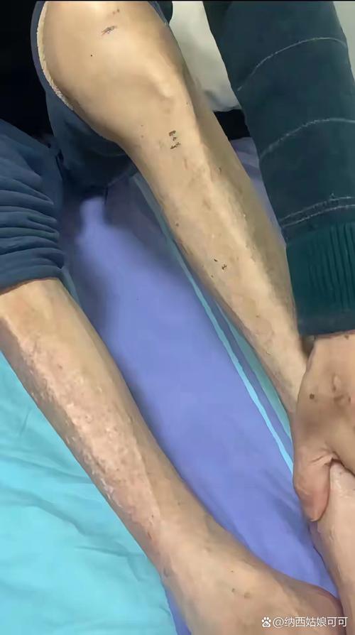 脑梗手指抽筋脚趾抽筋