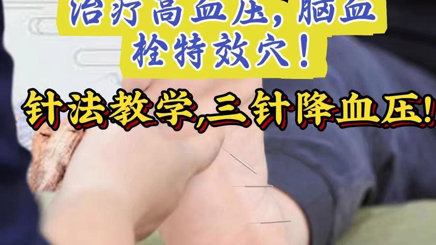 脑梗病人针灸需要多久