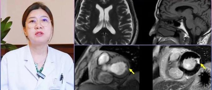 心肌梗塞 房颤 脑梗