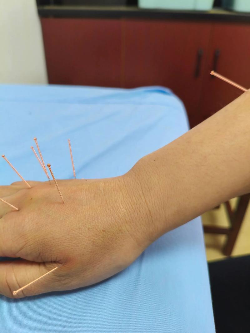 扑尔敏可以穴位注射吗