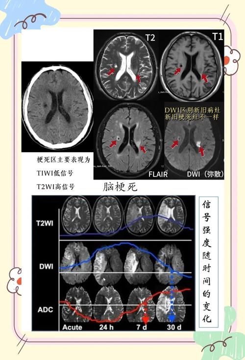 怎么辨别脑梗cT图片