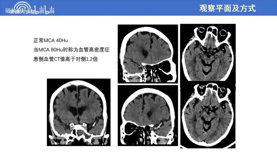 怎么辨别脑梗cT图片