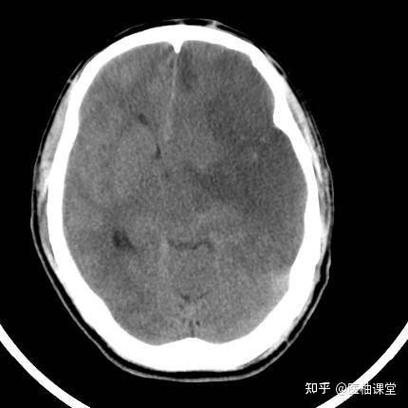 怎么辨别脑梗cT图片