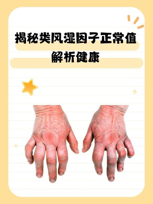 类风湿因子参考值是多少