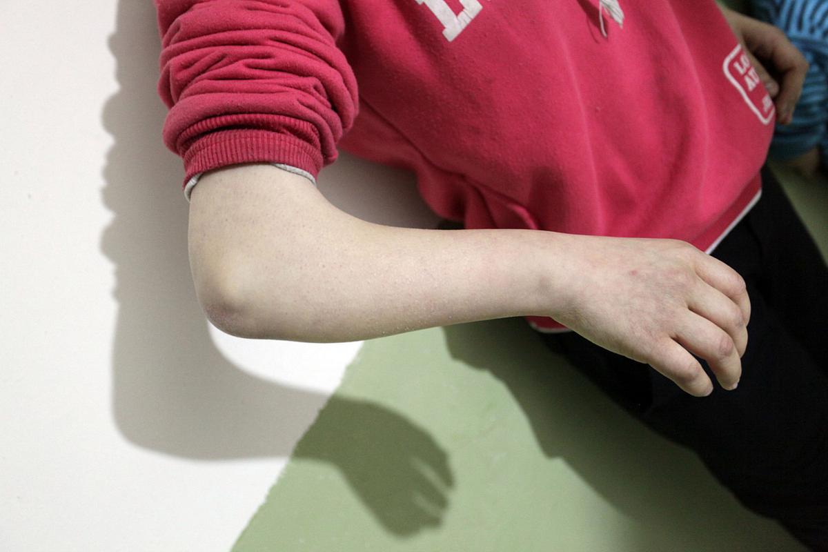 轻微脑梗总说胳膊没劲