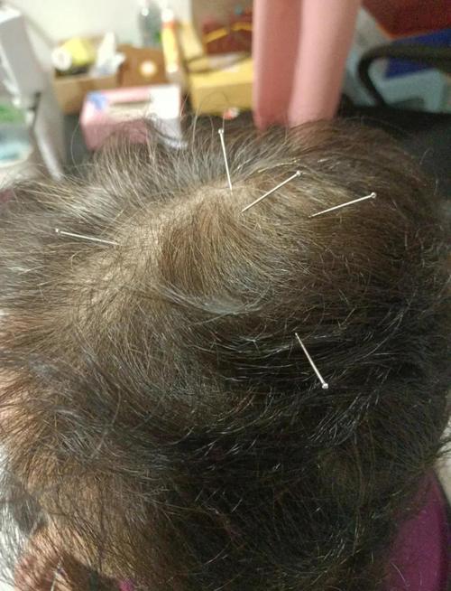 脑梗面瘫针刺什么学位