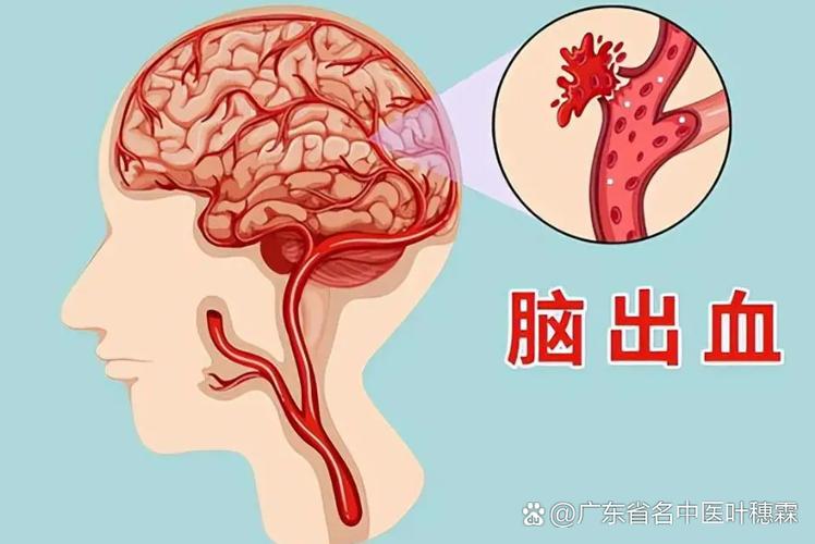 脑梗患者血压忽然变低