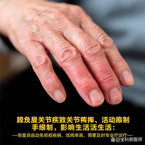 类风湿专科医院全国排名