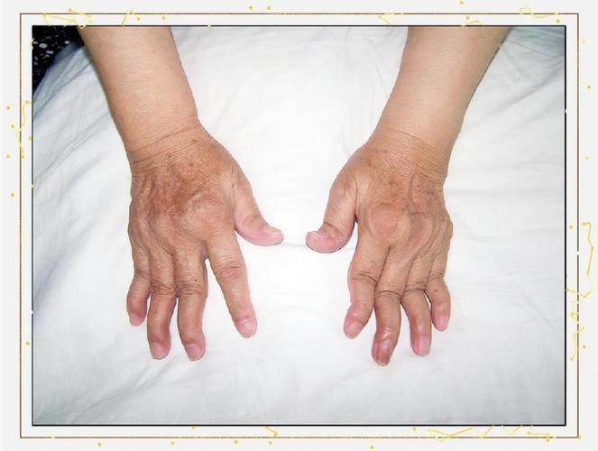 类风湿30多年没有再犯