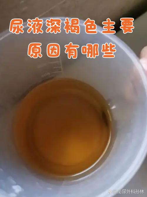脑梗病人尿液颜色褐色