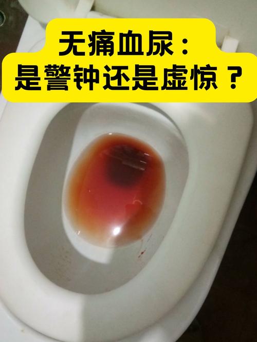 脑梗病人尿液颜色褐色