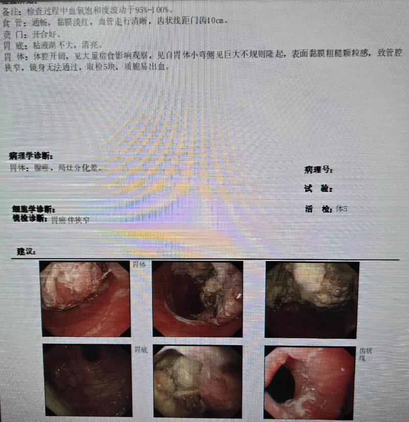 胃癌 脑梗可以手术么