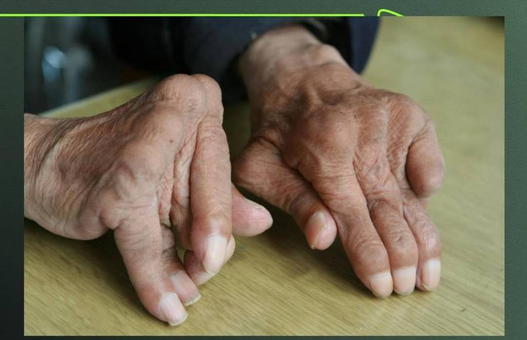 类风湿性关节炎晚期症状