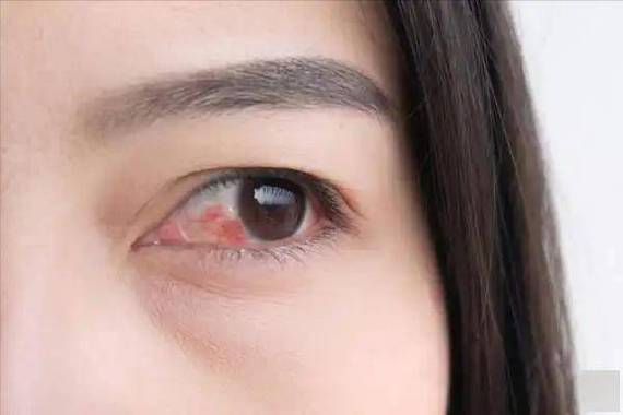 脑梗病人眼睛为啥冰冷