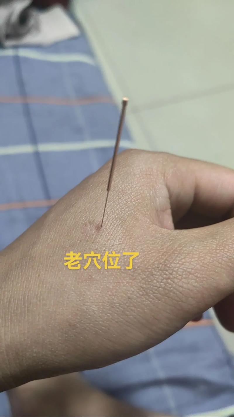 喉咙肿痛针灸那些穴位