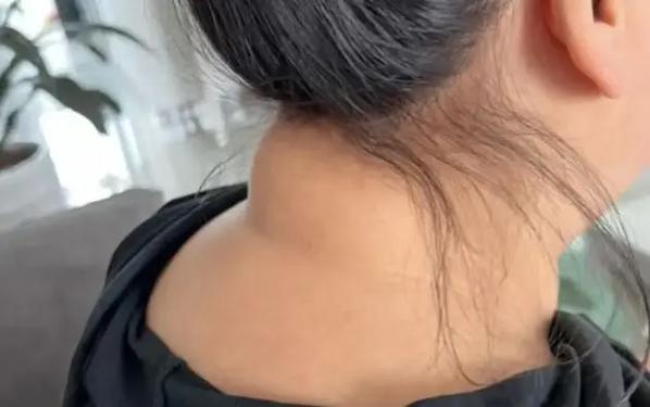 最近流口水 有过脑梗