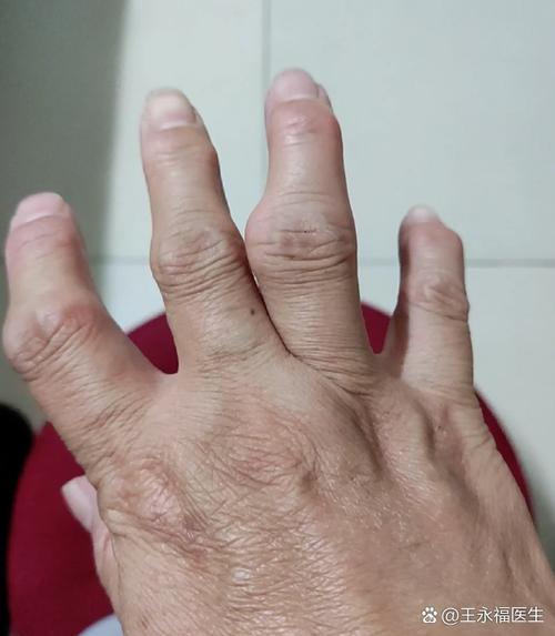 类风湿的初期症状是什么