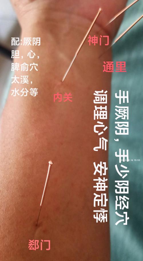 胸痛应该针灸什么穴位