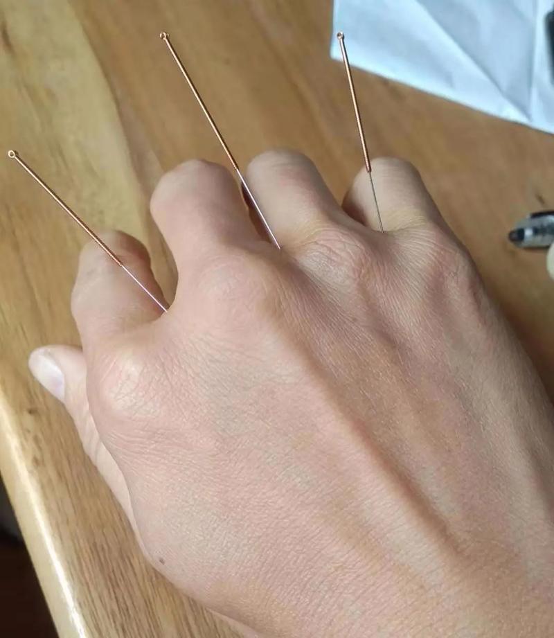 针灸哪些穴位比较危险