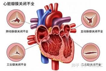 风湿性主动脉瓣关闭不全
