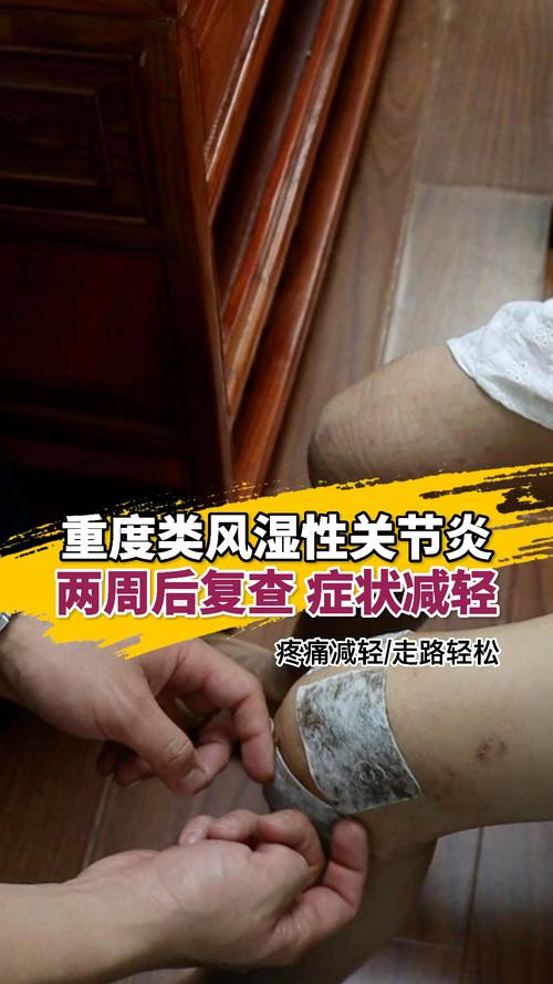 外敷治疗类风湿性关节炎