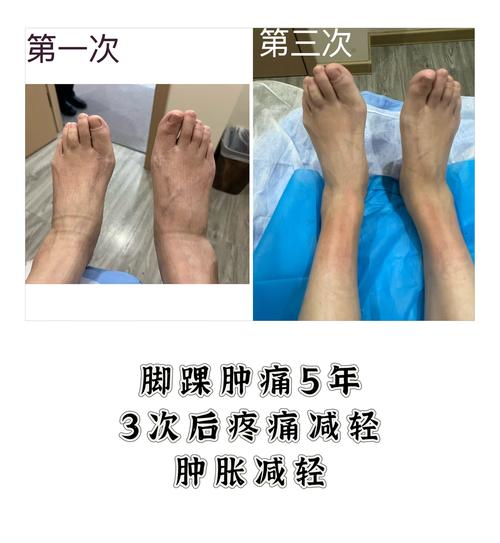 外敷治疗类风湿性关节炎