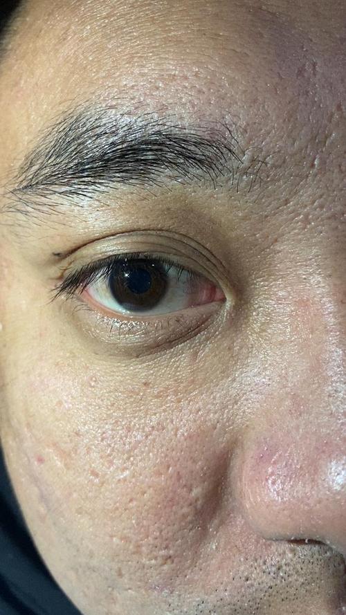 脑梗病人眼球不会转动