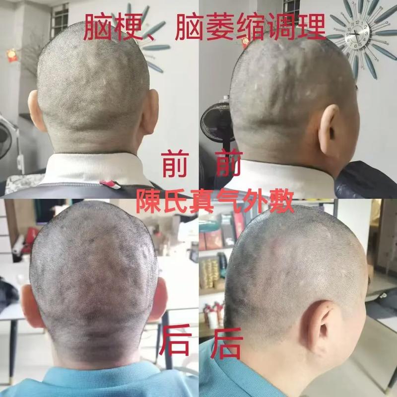 脑梗 脸歪 恢复正常