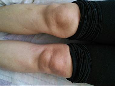 风湿性关节炎症状的表现