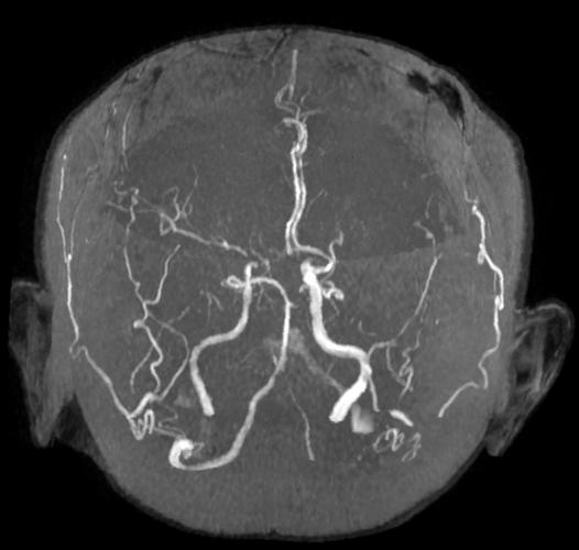 磁共振血管成像 脑梗
