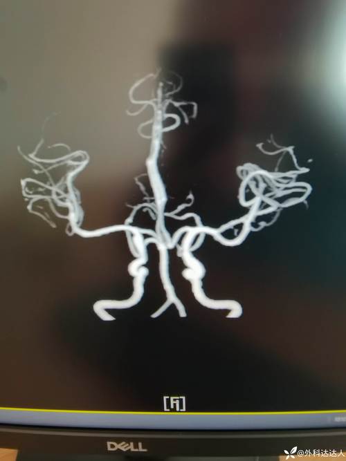 磁共振血管成像 脑梗