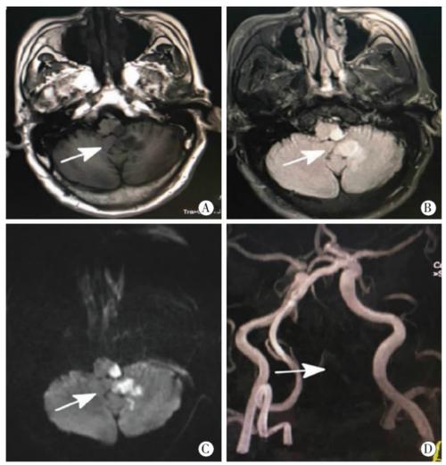 磁共振血管成像 脑梗