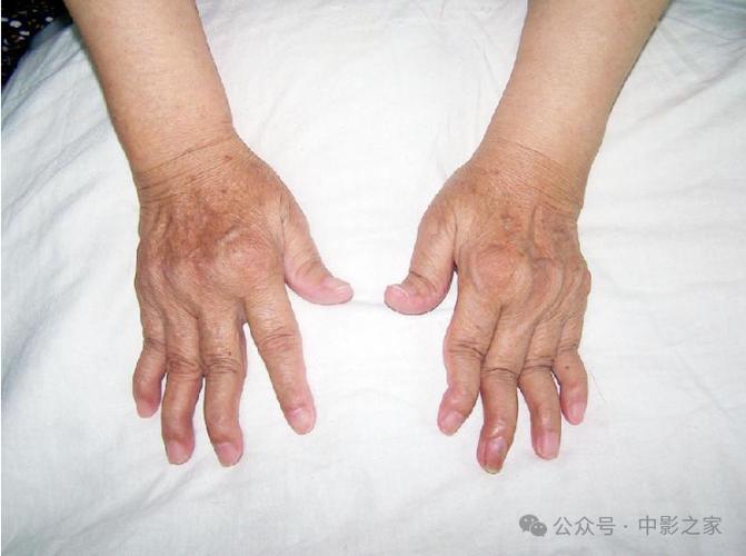 类风湿性关节炎x线表现