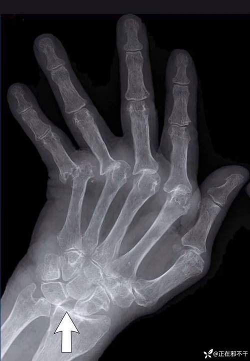 类风湿性关节炎x线表现