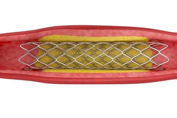 脑梗脖子血管堵塞支架