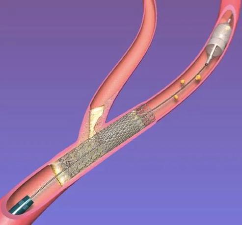 脑梗脖子血管堵塞支架