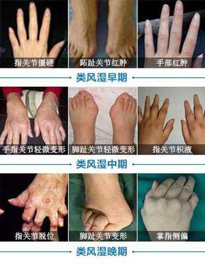 风湿性关节炎的初期症状