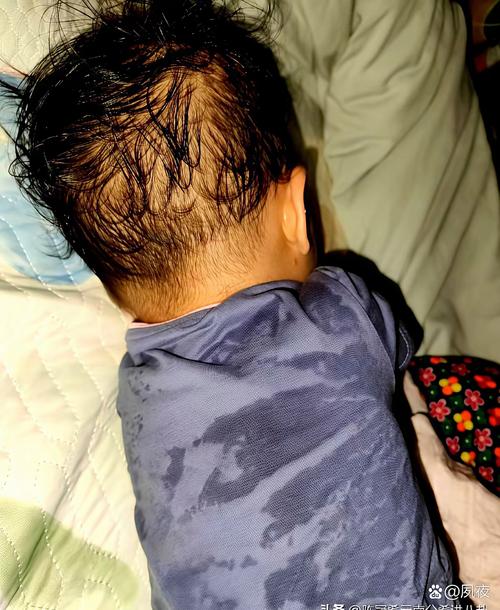 脑梗患者脸色发黑嗜睡