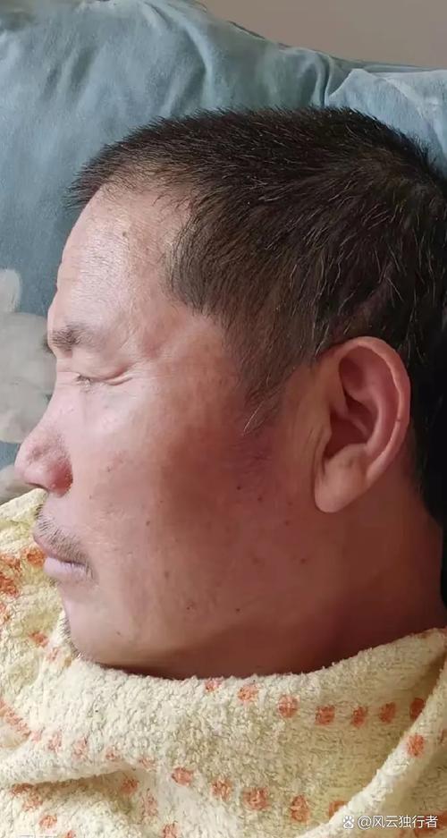 脑梗患者脸色发黑嗜睡