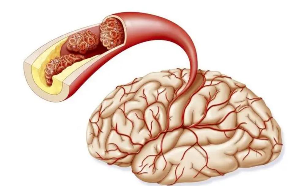 脑血栓 脑萎缩 脑梗