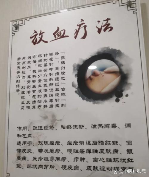 放血疗法60穴位讲解