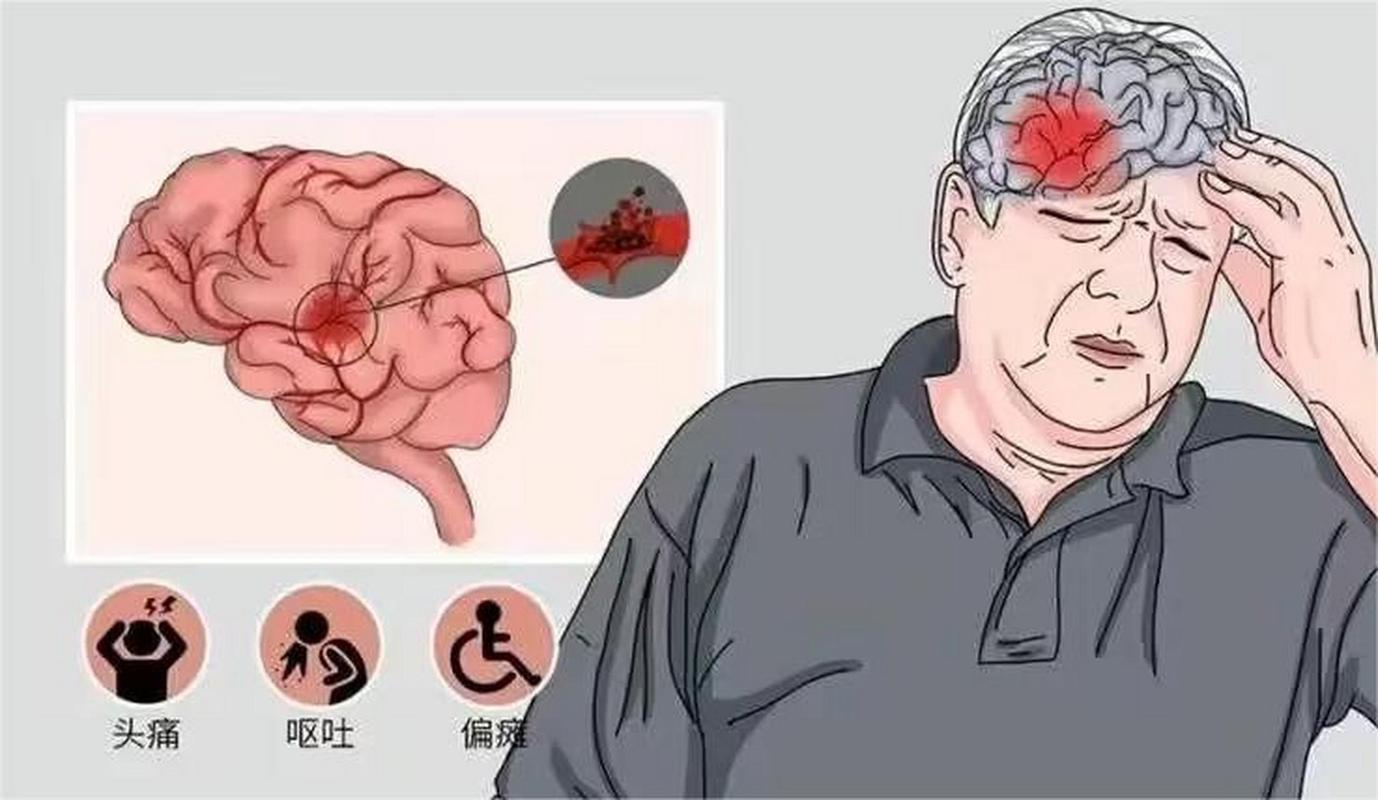 脑梗病人出现肺部感染