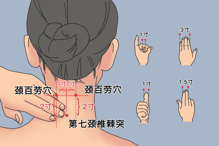 脖子扭伤针灸什么穴位