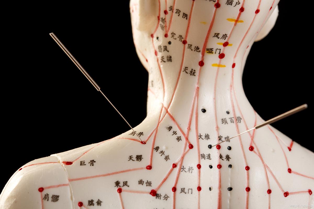 脖子扭伤针灸什么穴位