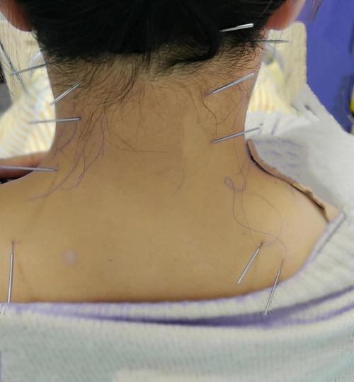 脖子扭伤针灸什么穴位