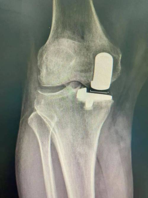 类风湿关节炎的关节置换